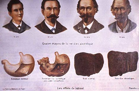 Quatre étapes alcoolisme - santé étudiant